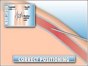 Correct needle position
