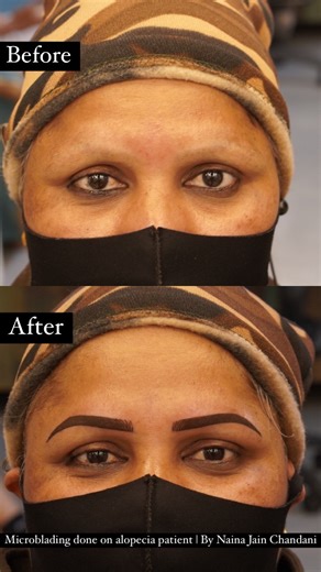 Happiness to life, eyebrows done on alopecia patient, Microblading by @nains_tattoos @skinmachinetattoo . #alopecia #microbladebrows #microblading #skinmachinetattoo | Skin Machine Tattoo Studio