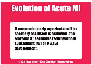 19K views · 149 reactions | Stages of Acute MI | The ECG Educator | Facebook