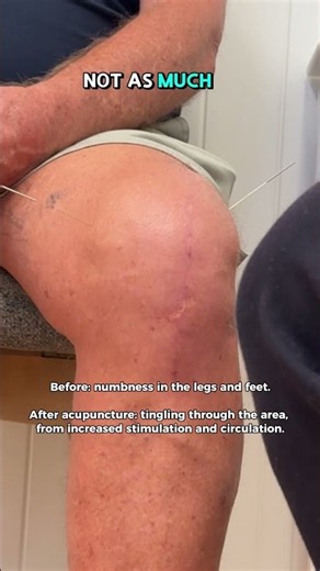 Why Did This Acupuncture Session Feel Different?