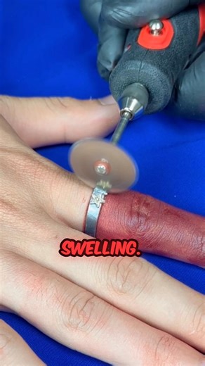 Ring Stuck on Finger 😨 I Tried Everything… This Finally Worked!