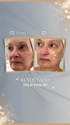 🇧🇷Quando a estrutura cede, o rosto perde contorno… Mas com o TKLifting 4D, conseguimos estimular o colágeno nas camadas mais profundas e devolver sustentação natural. ✨ Resultado VISÍVEL na primeira sessão. Comente TK se você deseja saber mais. 🇬🇧When the structure gives way, the face loses contour… But with TKLifting 4D, we can stimulate collagen in the deeper layers and restore natural support. ✨ VISIBLE result in the first session. Comment TK if you want to know more. #flacidezfacial #big