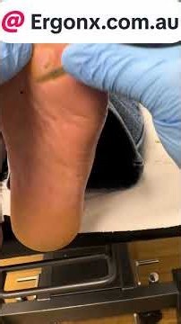 Satisfying Forefoot Callus Removal by Podiatrist #CallusRemoval #Podiatrist