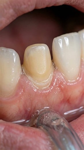 Dental Crown Restoration | Silver Crown Placement Animation #shorts