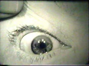 Opsoclonus