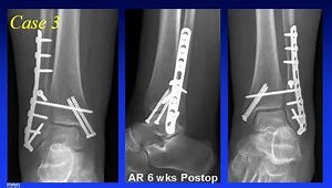 Case Discussion: Treatment of Distal Tibia Fractures