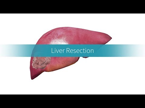 Liver Resection: How and Why the Procedure Is Performed