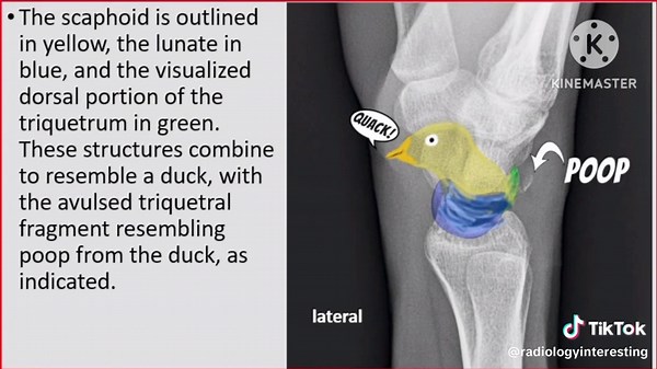 ‏Pooping duck sign on ultrasound #ultrasound #radiology #radiologist