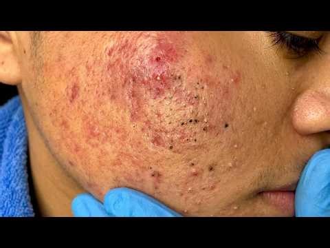 Blackhead removal with Sac Dep Spa | Satisfying and Relaxation with Sac Dep Spa #356431