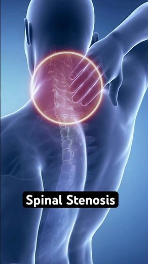 Spinal Stenosis: Explained in 3D