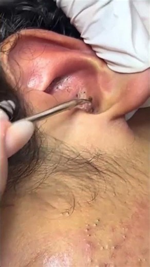 Blackhead Removal from the Ear That Will Leave You Amazed! 😱 #PimplePopping #Satisfying #Skincare