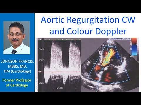 Aortic Regurgitation CW and Colour Doppler