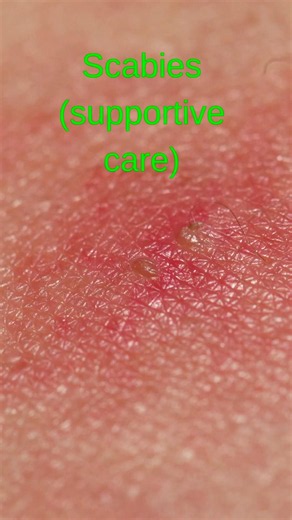 Scabies Treatment: Why Home Remedies Aren't Enough
