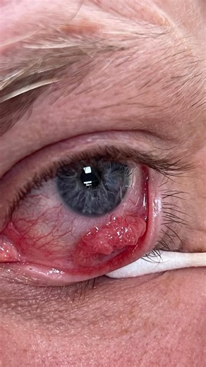 Eye Conditions Explained on Instagram: "👁️ A conjunctival squamous papilloma is a benign growth that develops on the conjunctiva, the clear membrane covering the white part of the eye and the inner eyelids. In this case, a 43-year-old Caucasian male presented with a left lower lid lesion that had been present for more than 10 years. On examination, the lesion was pedunculated, mobile, and multi-lobulated, located in the fornix. It measured approximately 11 mm at its widest point and appeared fl