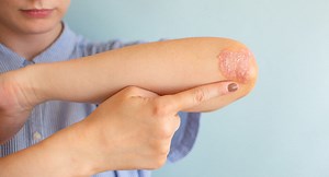 6 Psoriasis Treatment Options to Clear Your Symptoms Effectively