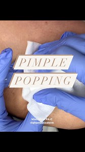 Mimi Phan PA-C | DALLAS FORT WORTH FILLER • BOTOX • SCULPTRA on Instagram: "Cystic Explosion! 💥 . . . . #pimplepopping #pimplepopper #pimples #poppingpimples #blackheads #pimple #blackheadremoval #explore #whiteheads #cyst #acne #popaholics #medicine #reels #explorepage #popping #blackheadextraction #poppingpimples #blackhead #dermatologist #dermatology #pops #popping #trending #trendingreels #drpimplepopper #explore"