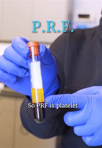 Healing, upgraded. 🩸 ✨ PRF, or Platelet-Rich Fibrin, is a next-level regenerative material created from your own blood. Here's the science 👇 We draw a small sample, place it into our medical-grade centrifuge, and spin it at a precise speed and time. That controlled spin separates the blood into layers, concentrating platelets, white blood cells, and growth factors into a powerful fibrin matrix. The result? High-quality PRF that we can use to: * ﻿﻿Support bone grafting * ﻿﻿Enhance implant heali