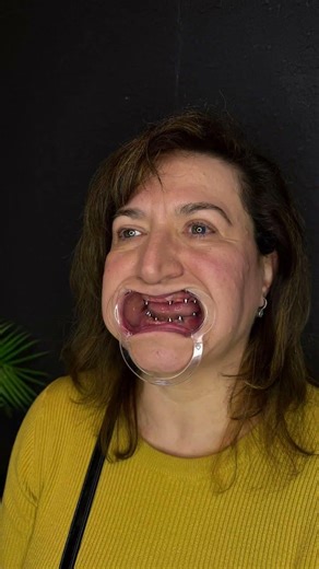 Dental implant before & after ✨ Strong, natural smile