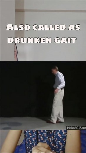 Common Gait Abnormalities & What Causes Them #doctor #physiotherapist #gaitpattern