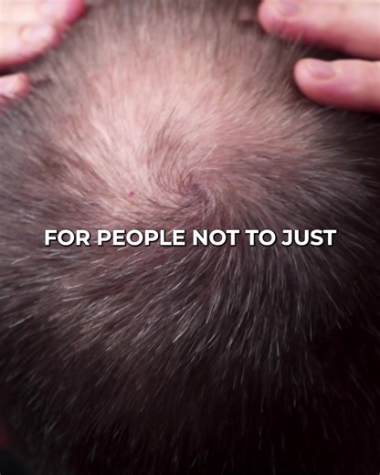 1.1K views · 24 reactions | Don’t get a hair transplant before...