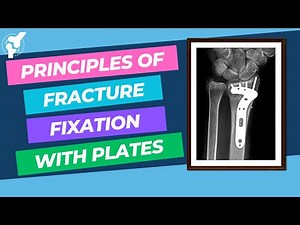 Biomechanics of Fracture Fixation • Video • MEDtube.net