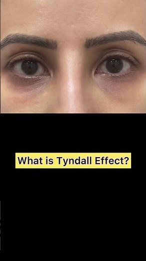 What is the Tyndall Effect in aesthetics?