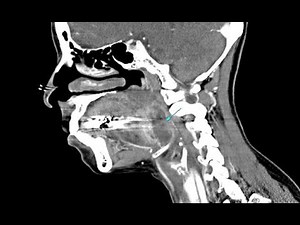 Peritonsillar abscess I&D