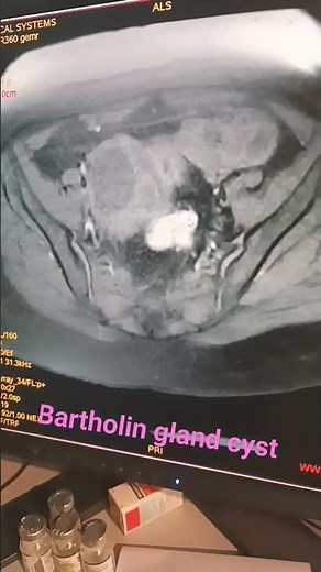 Bartholin gland cyst