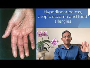 Hyperlinear palms, eczema and food allergies