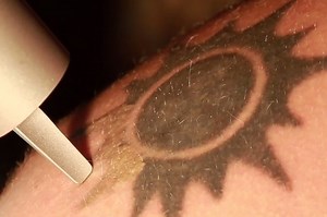 Here's How Getting A Tattoo Removed Works