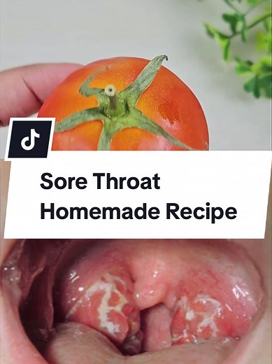 if your throat hurts so much that you canette even swallow you own saliva, you need to try this. if your throat hurts, and medication isn't working for you, try this, and you'll thank me #sorethroat #sorethroatremedy #relief #pain #sorethroatrelief . . Sore Throat Homemade Recipe. Fix Your Sore Throat Overnight With this natural Recipe. #naturalremedy #naturalremedies #remedy #recipes #recipe #usa🇺🇸 #american #UK #irland #england🇬🇧