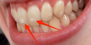 Here's why some people have white spots on their teeth
