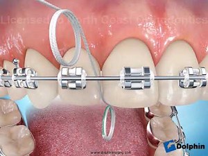 flossing with superfloss