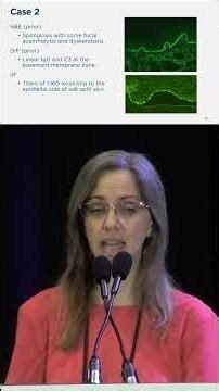 Checkpoint Inhibitor Rash - Diagnosis & Treatment Explained