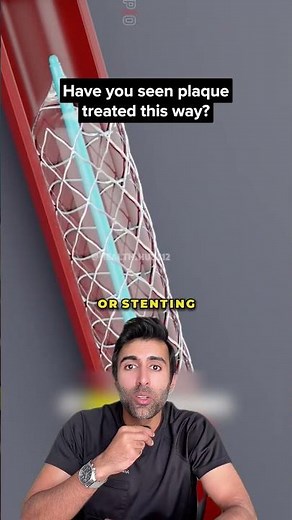 How Atherectomy Removes Hardened Plaque From Arteries