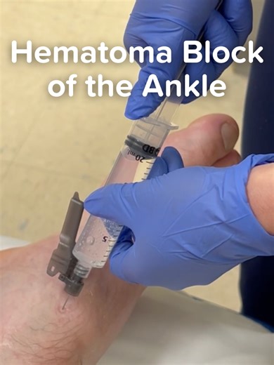 Ankle hematoma block 🦴💉 = targeted analgesia, fewer resources, faster throughput ⏱️ Perfect when sedation is risky ⚠️ or time is tight. Just inject local anesthetic into the fracture hematoma, wait 5–10 minutes ⌛, and reduce. Simple technique. Big impact. 💥 Add it to your ED playbook 📚 Save this for your next ankle reduction 🔖 or share with a resident who needs this pearl 👩‍⚕️👨‍⚕️✨ Check out our incredible library of procedure videos 🎥 — all included with your EMRAP subscription. #Emerge