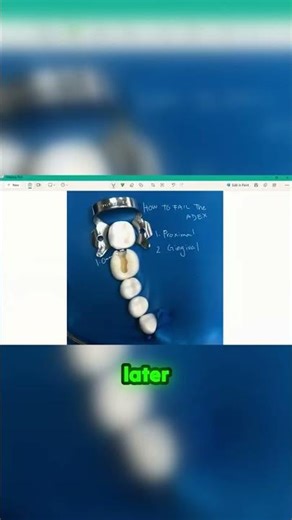 The 1mm secret to perfect Class II fillings!