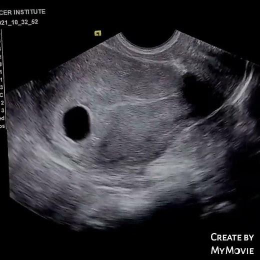 Early pregnancy showing gestational sac without yolk sac or embryonic node | ultrasound