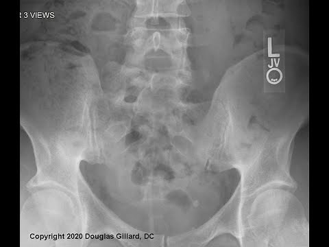 Posterior Sacral Anatomy + Two Malformations of the Lumbosacral Joint: Sacralization + Lumbarization