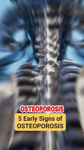5 Early Signs of Osteoporosis Courtesy: J Parker MD #osteoporosis #signsofosteoporosis #health #healthtips #Wellness #healthcare #HealthAwareness #osteoporosisawareness | Mommy Che