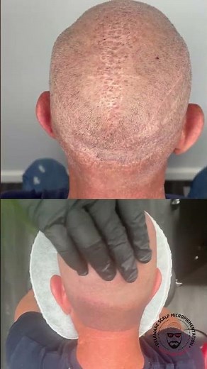 Botched Hair Transplants Fixed with SMP | Scar Camouflage