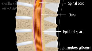 Lumbar Epidural Steroid Injection Animation. on Make a GIF