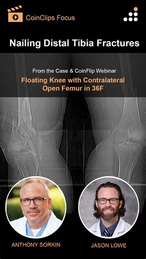 Here is a clip from our latest CoinFlips & Controversies Webinar Implant Discussion, titled “Floating Knee with Contralateral Open Femur in 36F”. In this CoinClip, Dr. Sorkin* from the Indiana Joint Replacement Institute and Dr. Lowe* from the University of Arizona discuss nailing distal tibia fractures when performing definitive fixation of a floating knee with contralateral open femur with the T2 Alpha™ Femur Retrograde Nailing System and the T2 Alpha™ Tibia Nailing System. Click here to watch