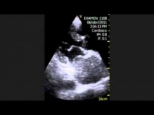 Extrinsic Compression Of The Left Atrium • Video • MEDtube.net