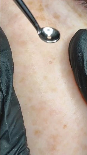 Milia Extraction on the Cheek | Skincare Close-Up