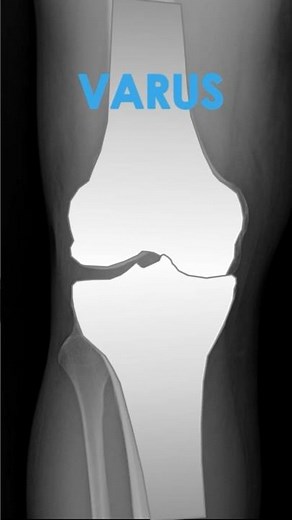 Varus - Valgus Deformities of the Knee on X-Ray #kneepain #radiology #anatomy