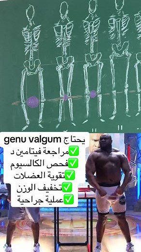 تعرف على حالة genu valgum وكيفية علاجها
