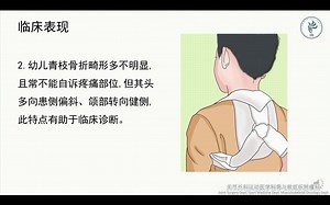 锁骨骨折患者的健康教育