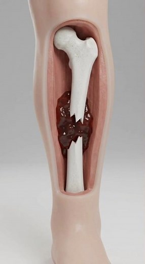 How Your Body Fixes A Broken Bone 🦴