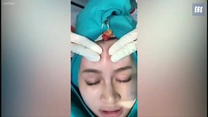 266K views · 927 reactions | Huge Amount Of Pus Drained From Woman’s Forehead Follow us on Instagram: https://www.instagram.com/doctorpimple/ | Doctor Pimple | Facebook